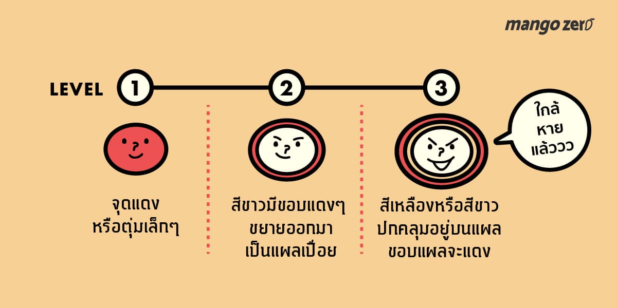 things-toknow-about-mouth-ulcer-04